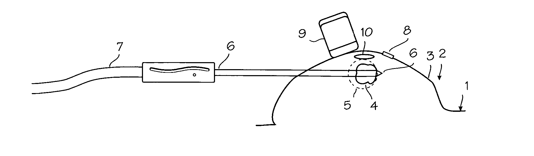 Method and system for cryoablating fibroadenomas