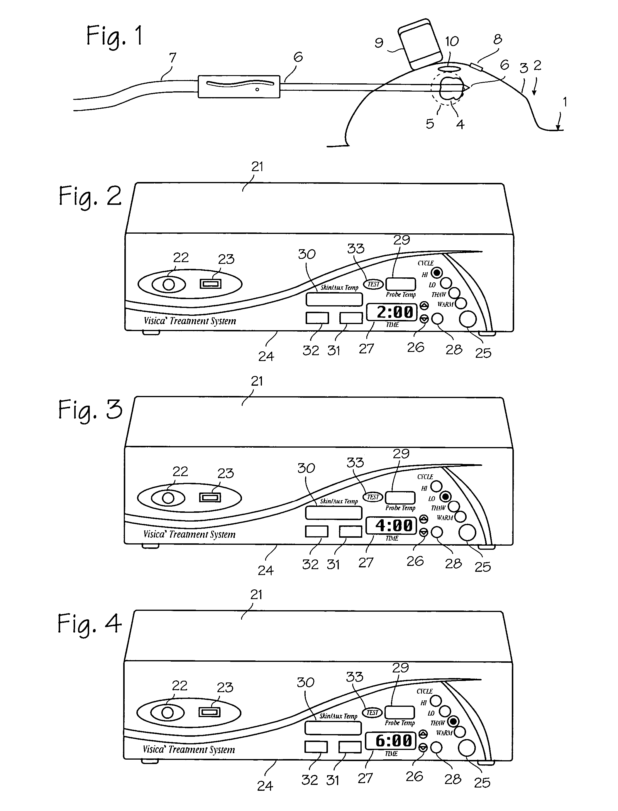 Method and system for cryoablating fibroadenomas