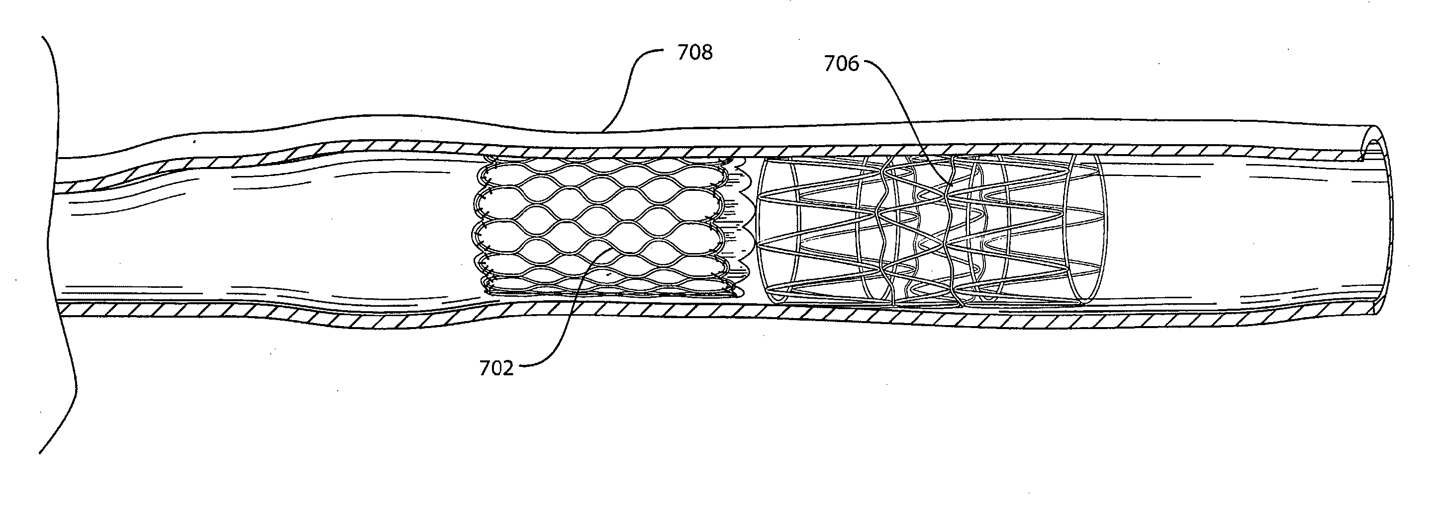 Stent Foundation for Placement of a Stented Valve