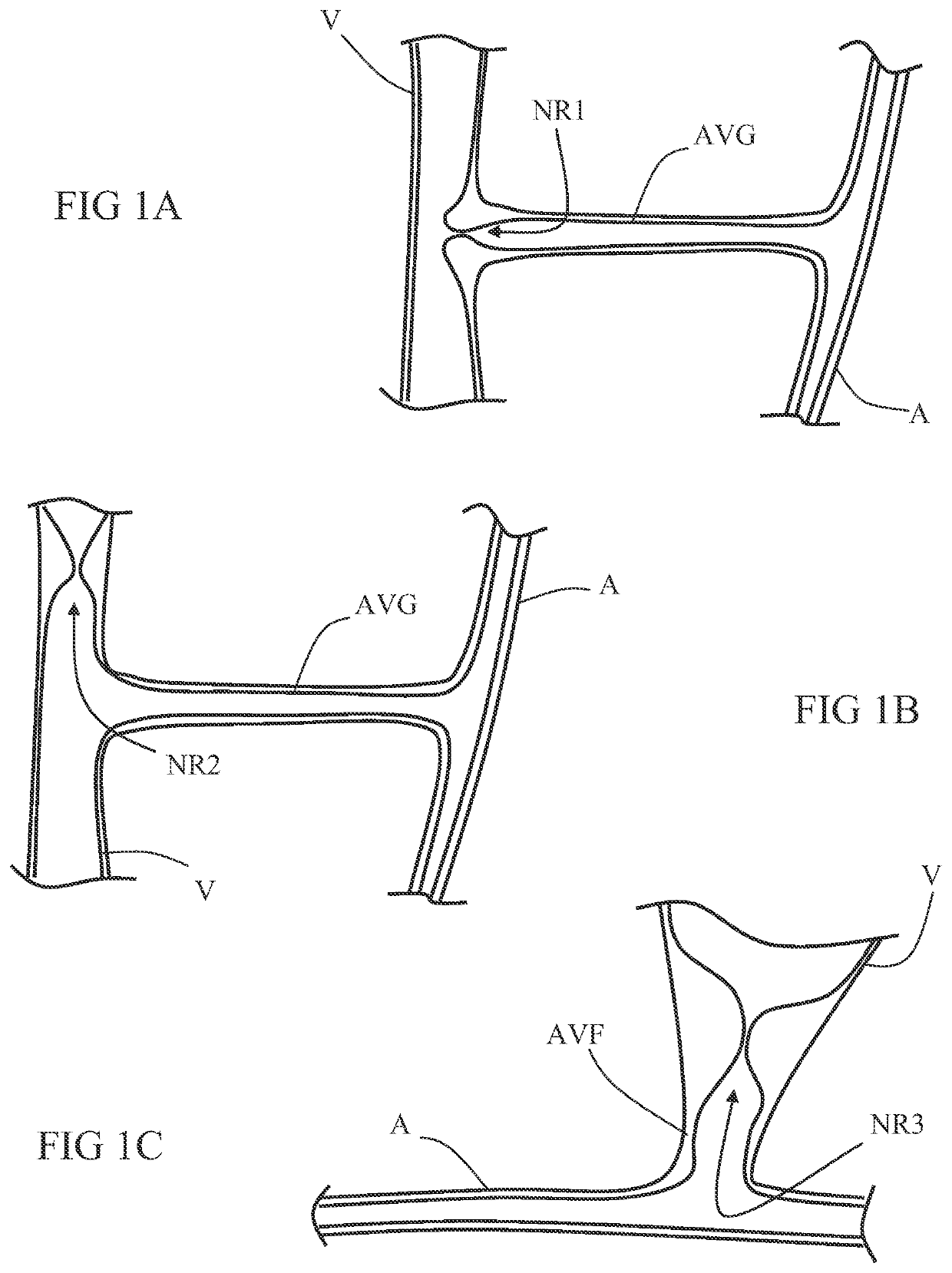 Disrupting fibrin sheath from a host blood vessel and visualization thereof