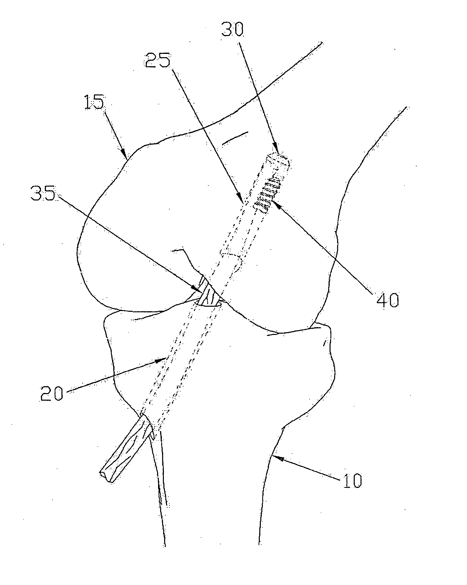 Apparatus and method for reconstructing a ligament