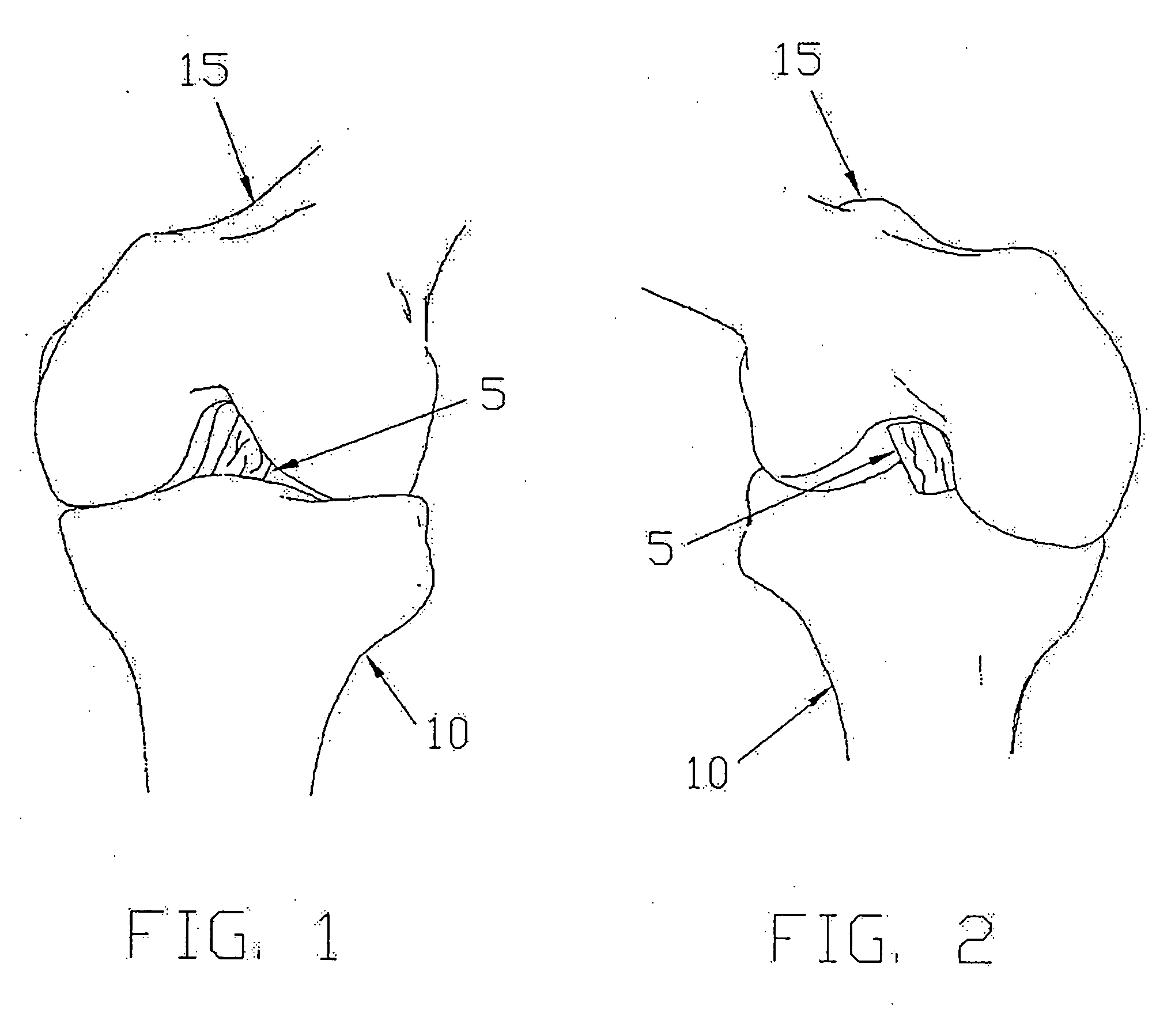 Apparatus and method for reconstructing a ligament