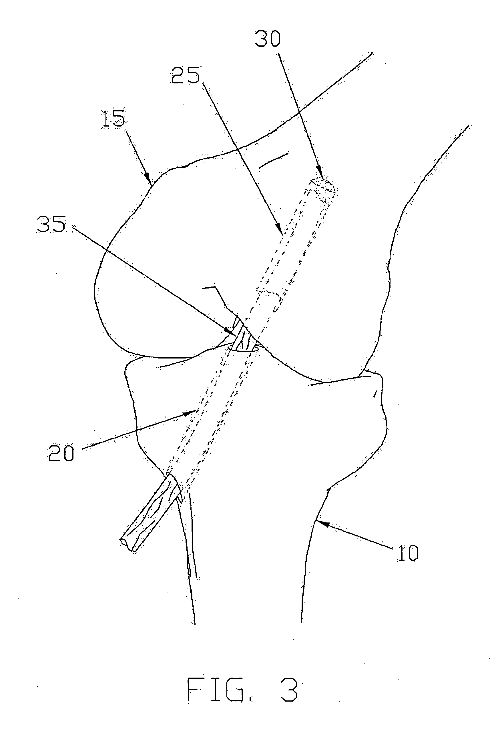 Apparatus and method for reconstructing a ligament