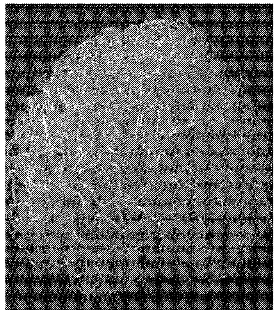 Minimally Invasive Focused Ultrasound (MIFUS) for Brain Surgery