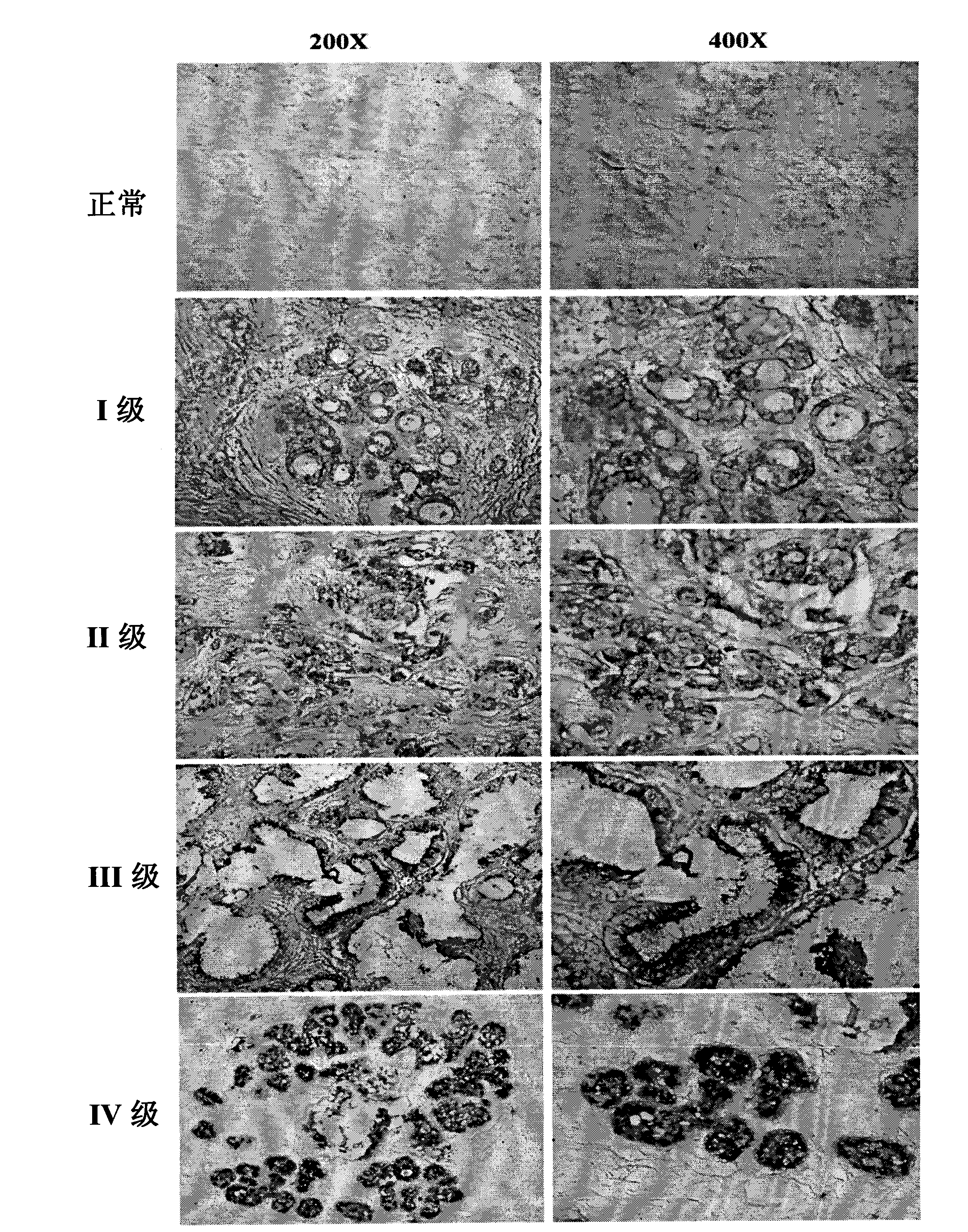 Molecular marker hsa-miR-374a of breast carcinoma and application thereof