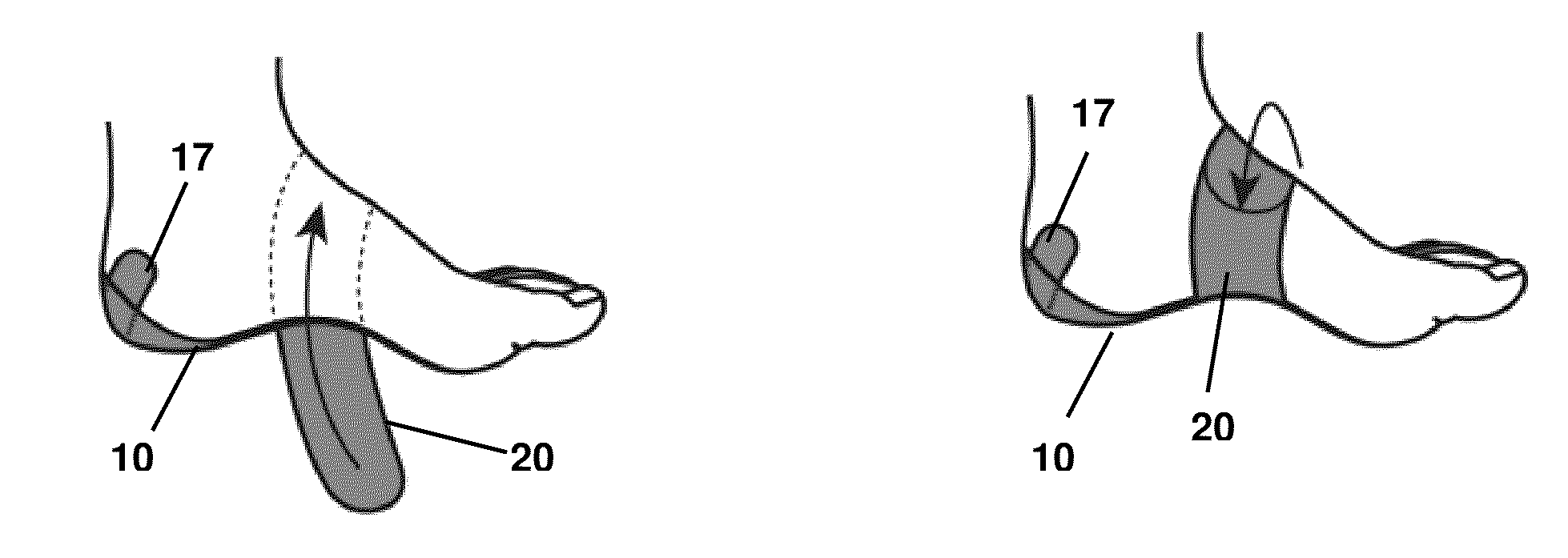 Disposable Two-Part Orthotic Foot Support Strap System And Method