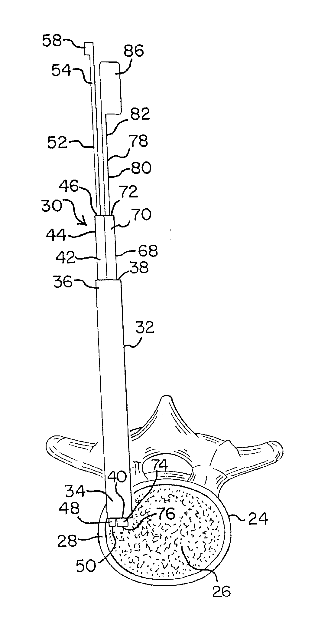 Apparatus and methods for disrupting intervertebral disc tissue