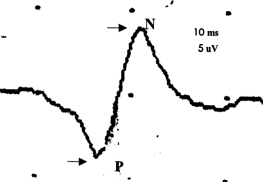 Bone marrow interstital stem cell preparation and its combined use with controlled release neurotrophic factor