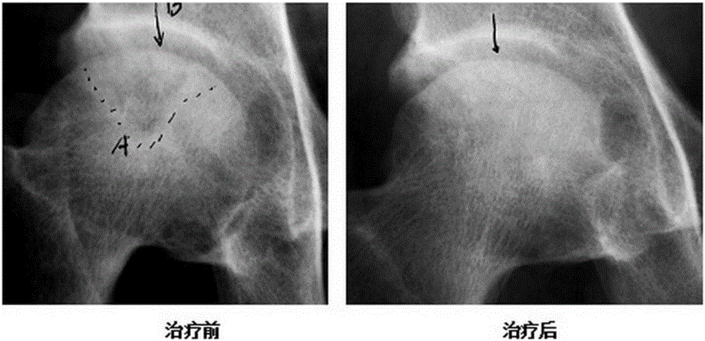 Drug for treating osteonecrosis and promoting bone repair