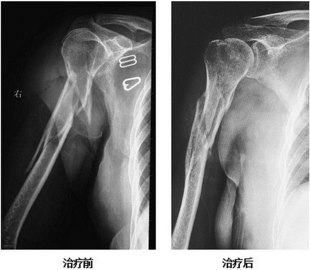 Drug for treating osteonecrosis and promoting bone repair