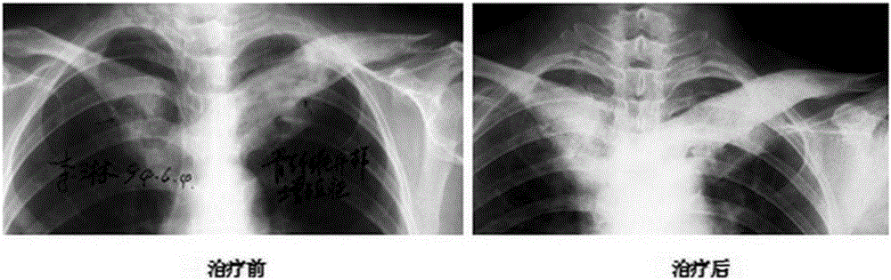 Drug for treating osteonecrosis and promoting bone repair