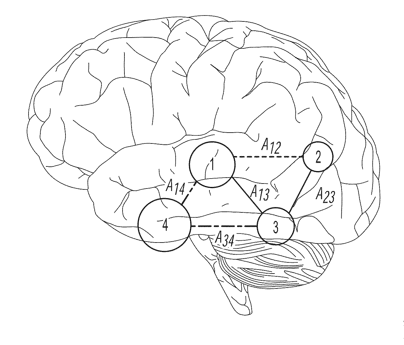 Computatonal tool for pre-surgical evaluation of patients with medically refractory epilepsy