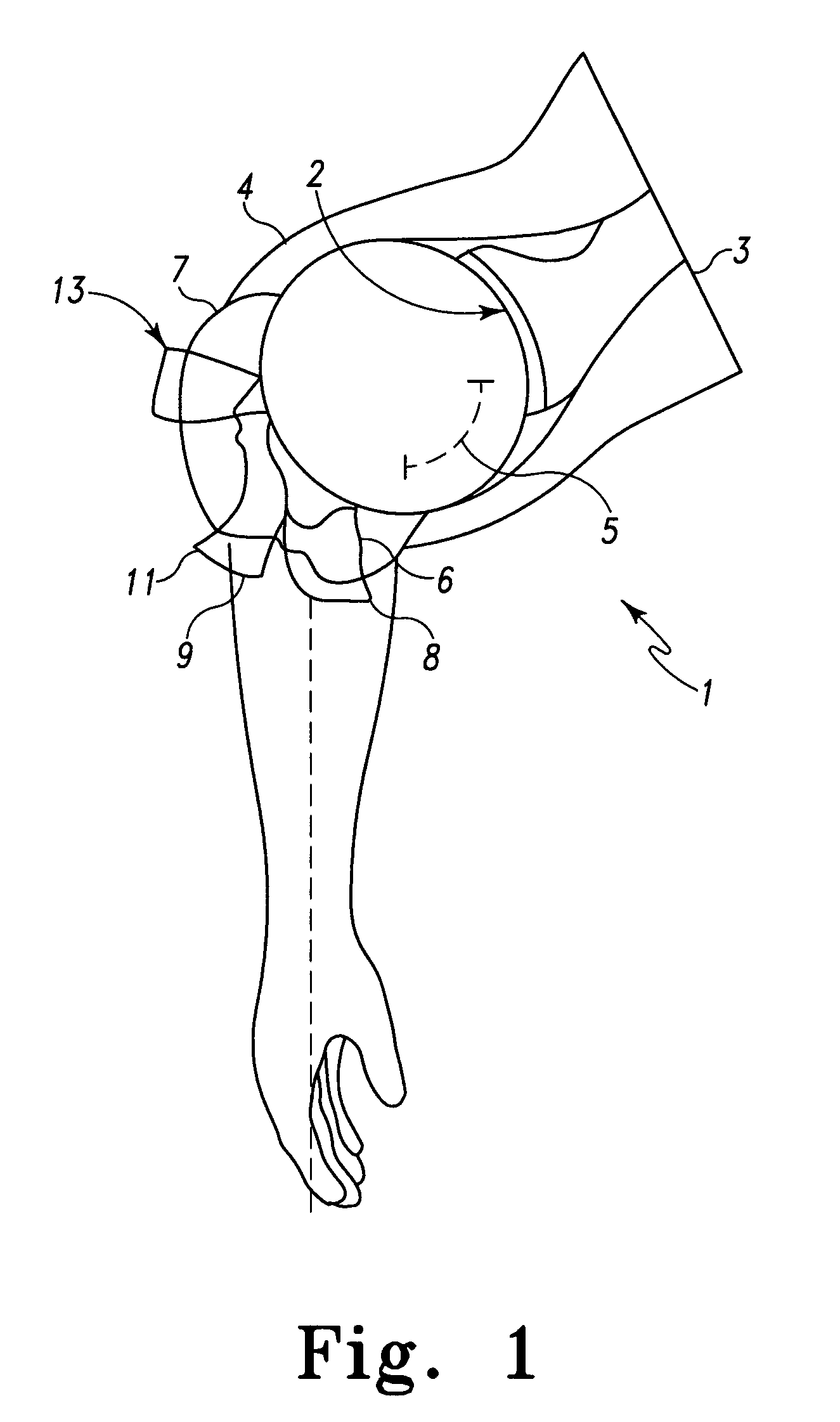 Orthopaedic stem with protrusion and associated surgical procedure