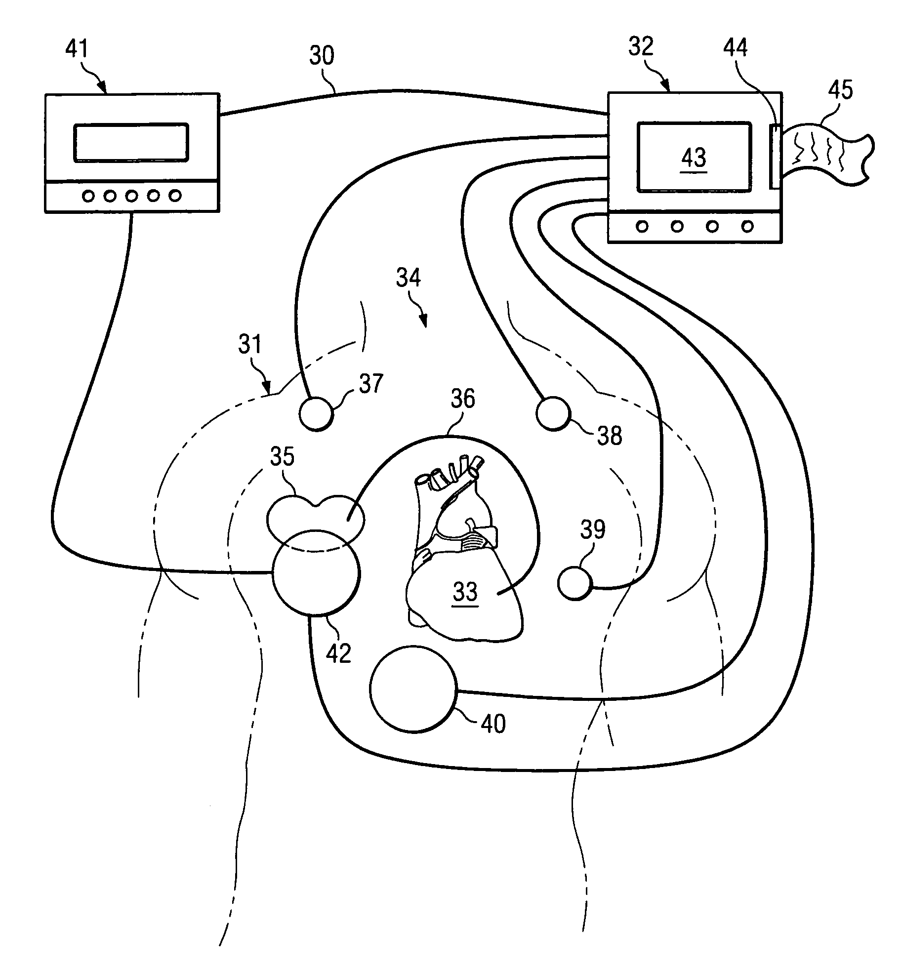 Optimization method for cardiac resynchronization therapy