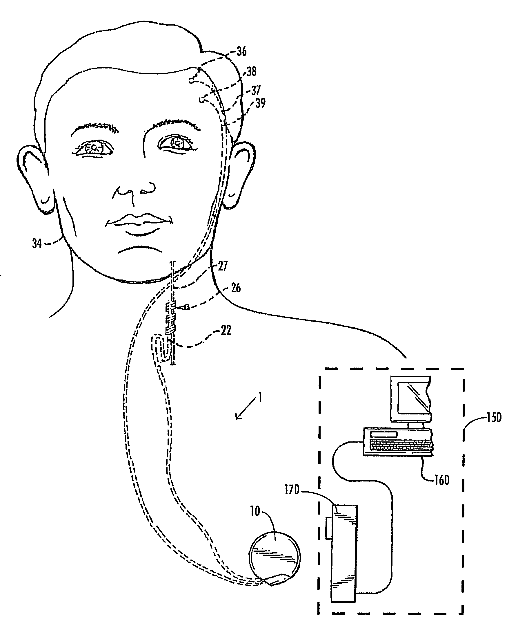 Selective neurostimulation for treating epilepsy