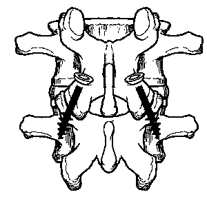 Single screw type percutaneous zygopophysis pedicle screw internal fixation system