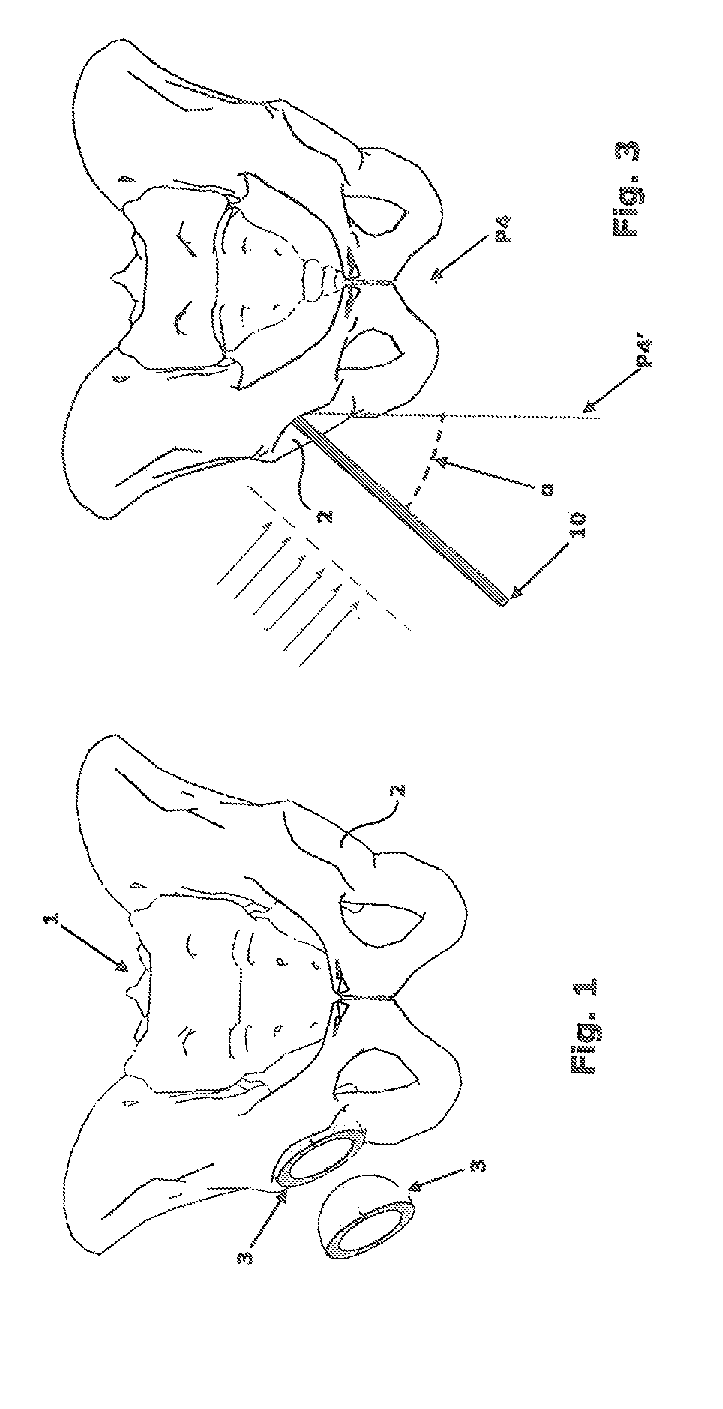 Apparatus for the orientation and positioning of surgical instruments and of implantation prosthesis in a bone seat