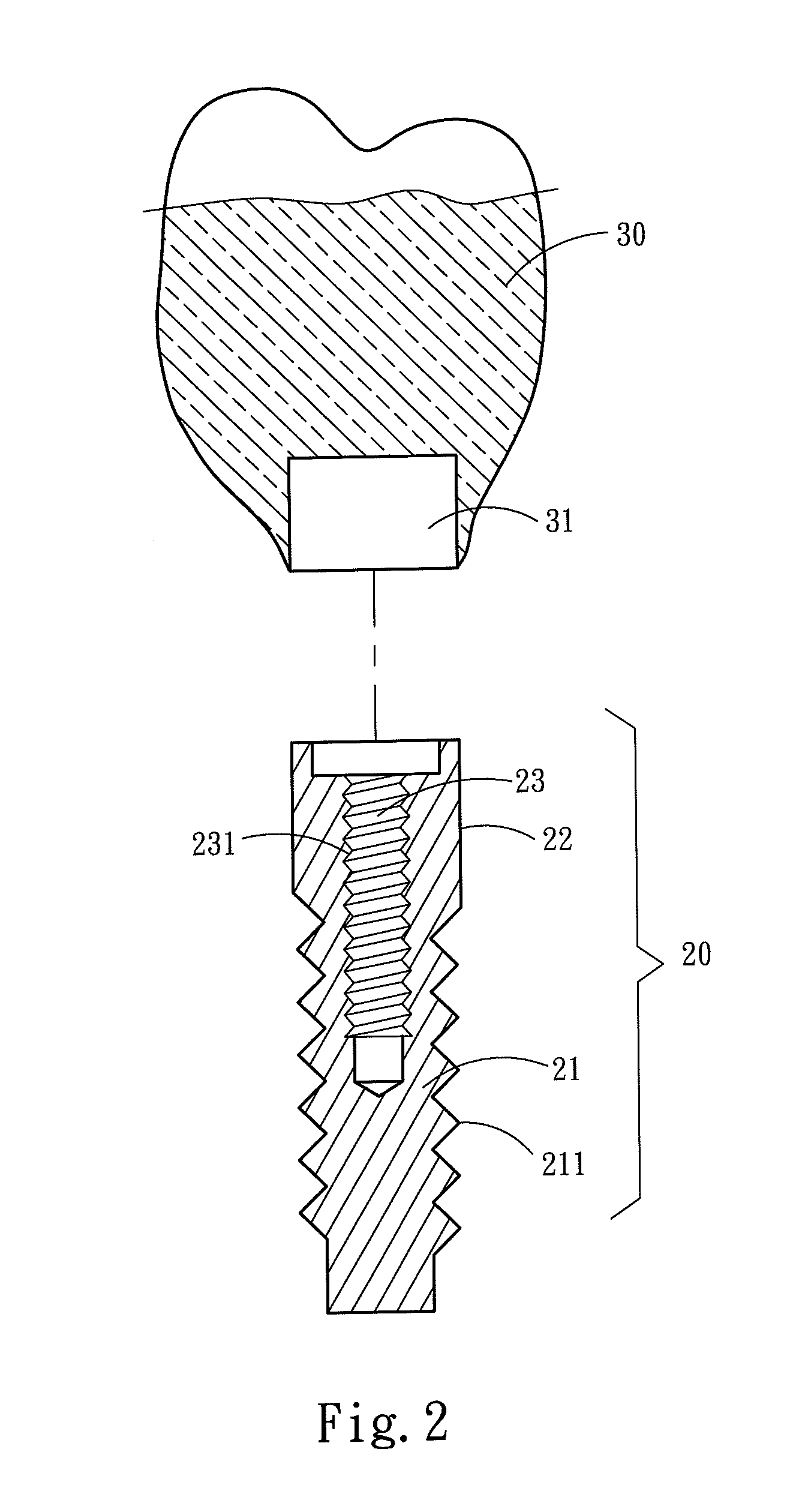 Universal dental implant structure