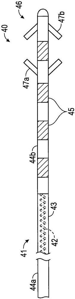 Electrode leads for use with implantable neuromuscular electrical stimulator