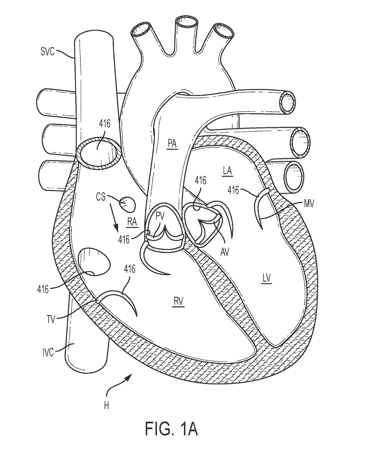 Docking stations for transcatheter valves