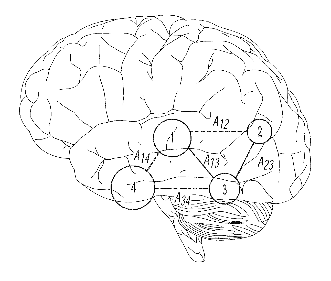 Computatonal tool for pre-surgical evaluation of patients with medically refractory epilepsy