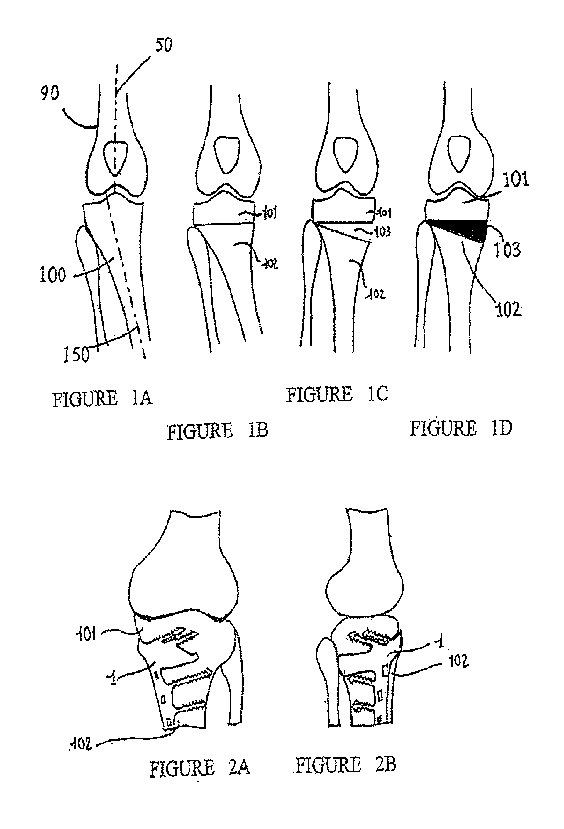 Osteosynthesis device