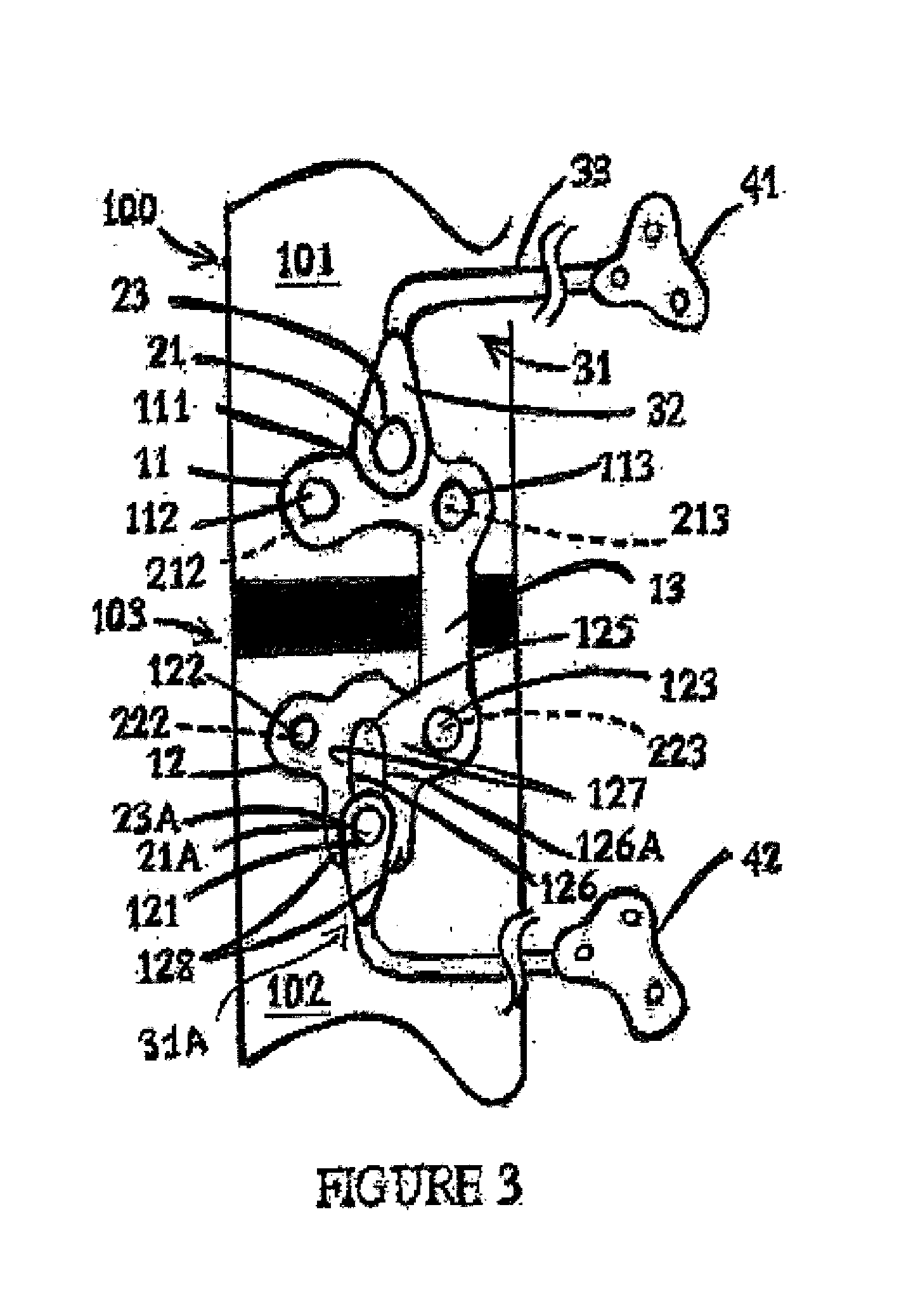 Osteosynthesis device