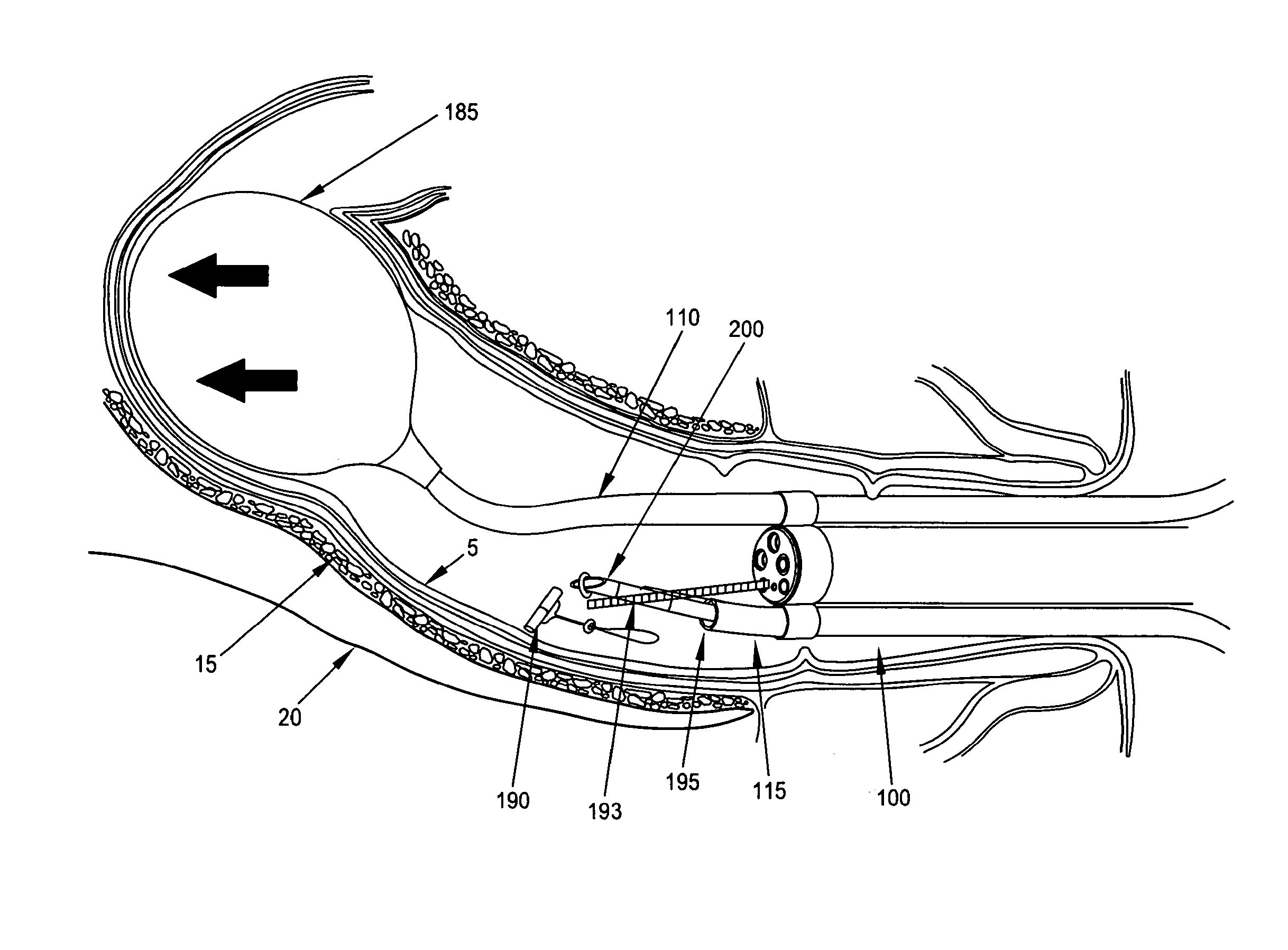 Method and apparatus for endoscopically treating rectal prolapse