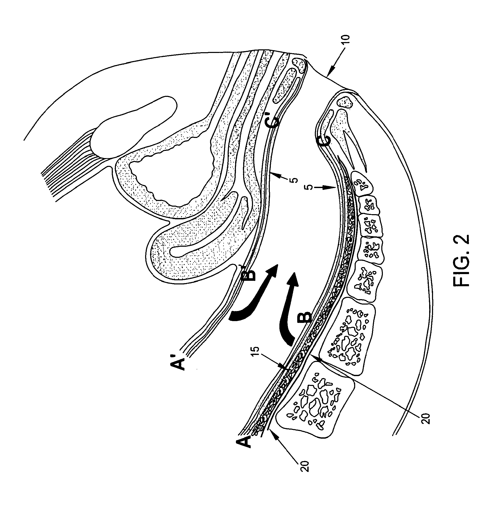 Method and apparatus for endoscopically treating rectal prolapse