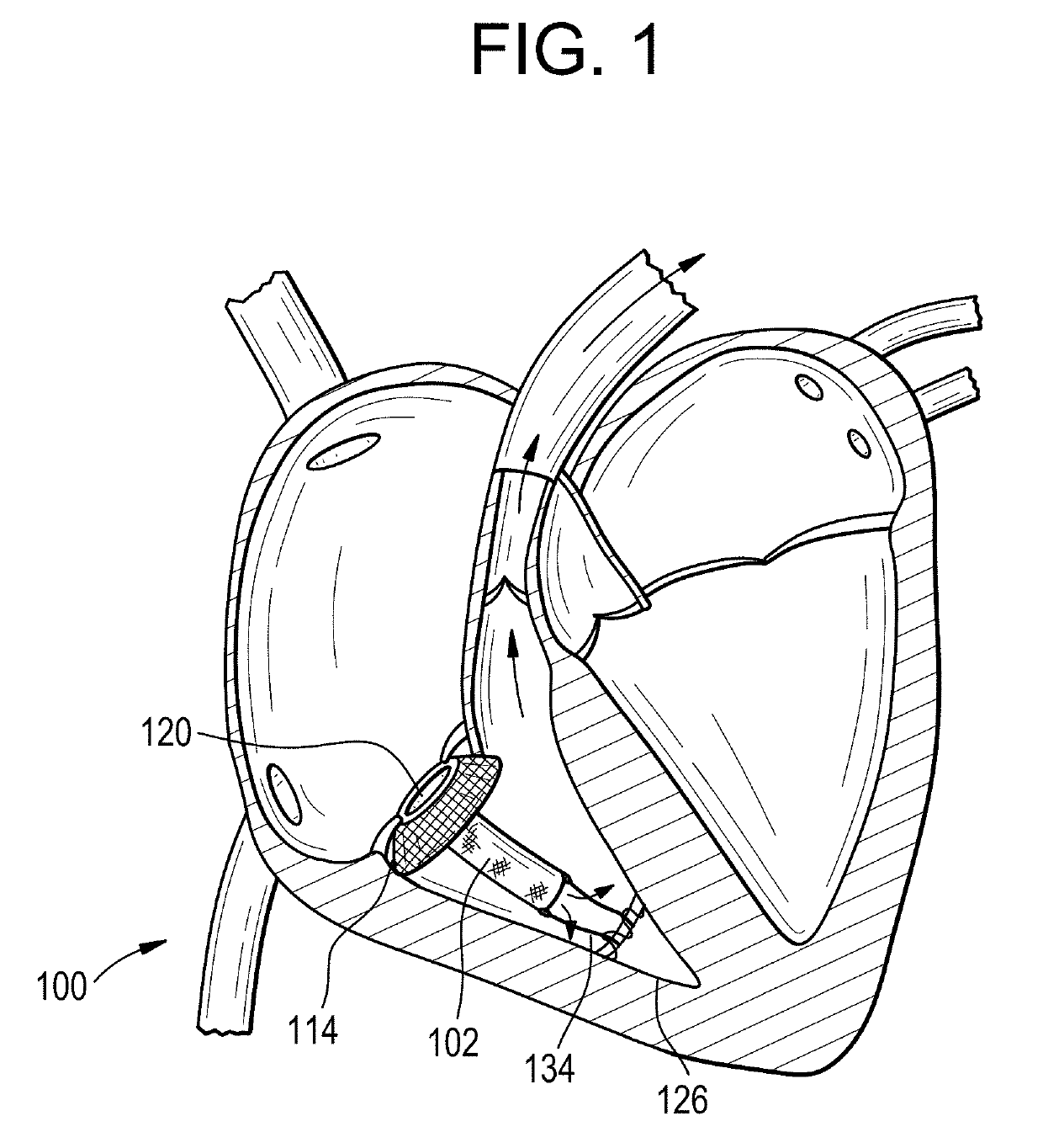 Septomarginal trabecula attachment for heart valve repair