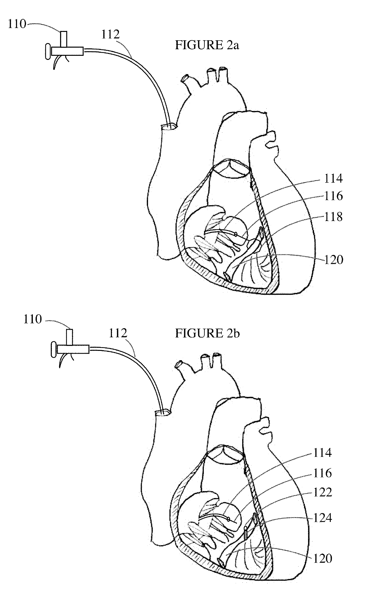 Septomarginal trabecula attachment for heart valve repair