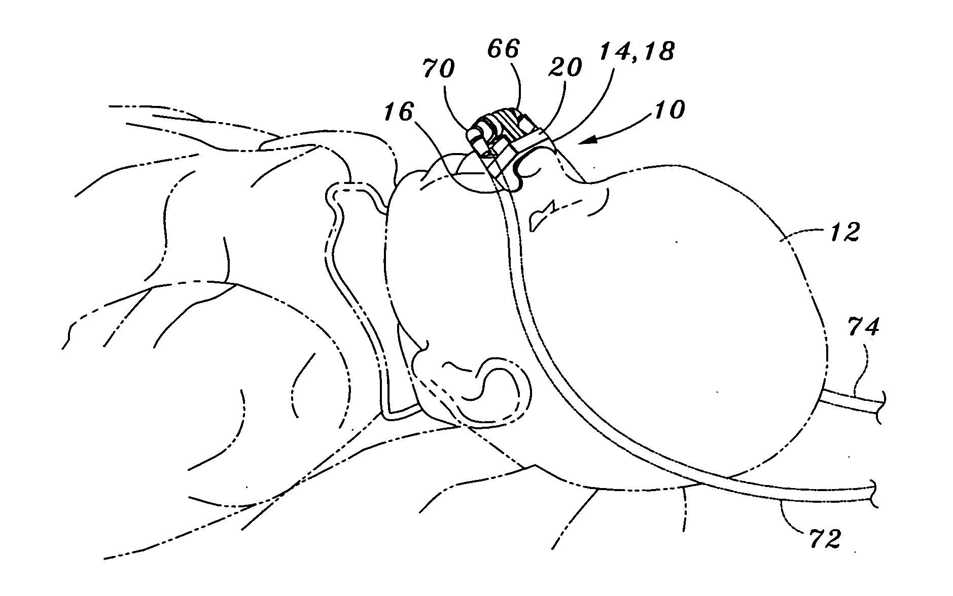 Venturi geometry design for flow-generator patient circuit