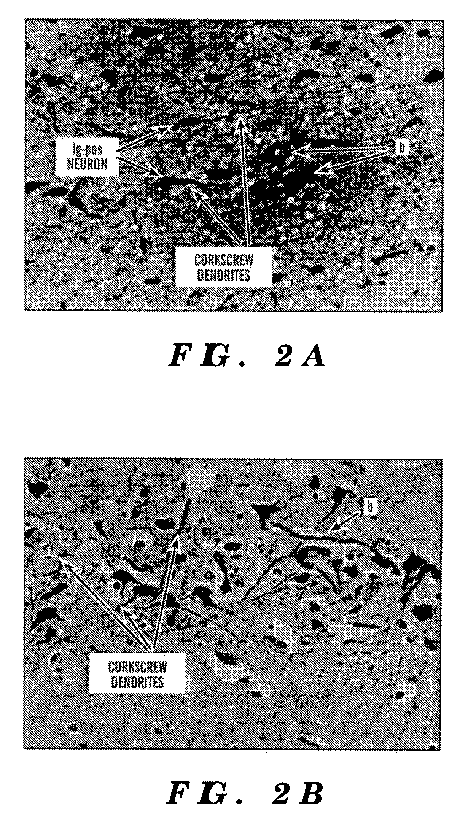 Methods of treatment and prevention of neurodegenerative diseases and disorders