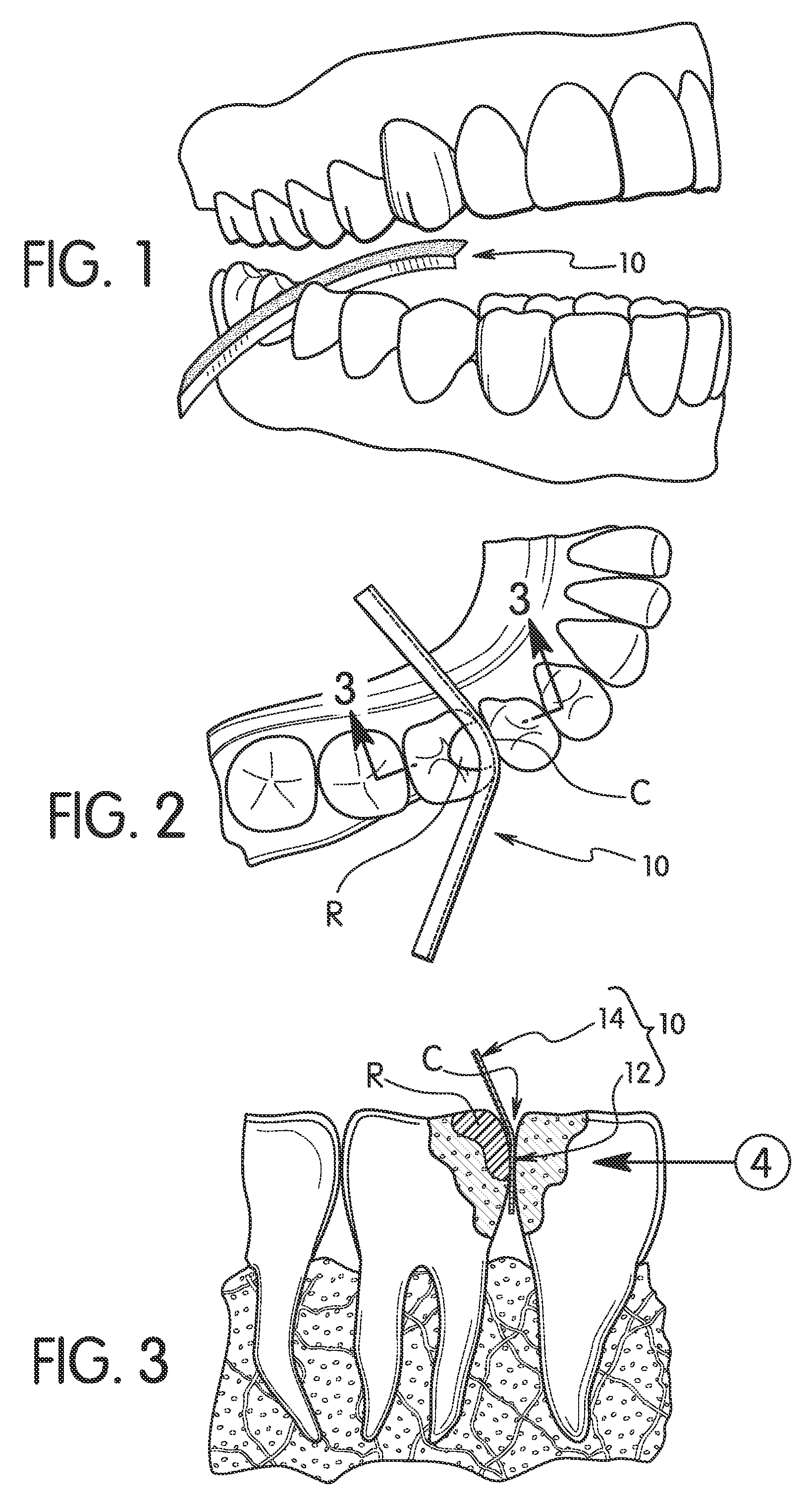 Dental shaping strip