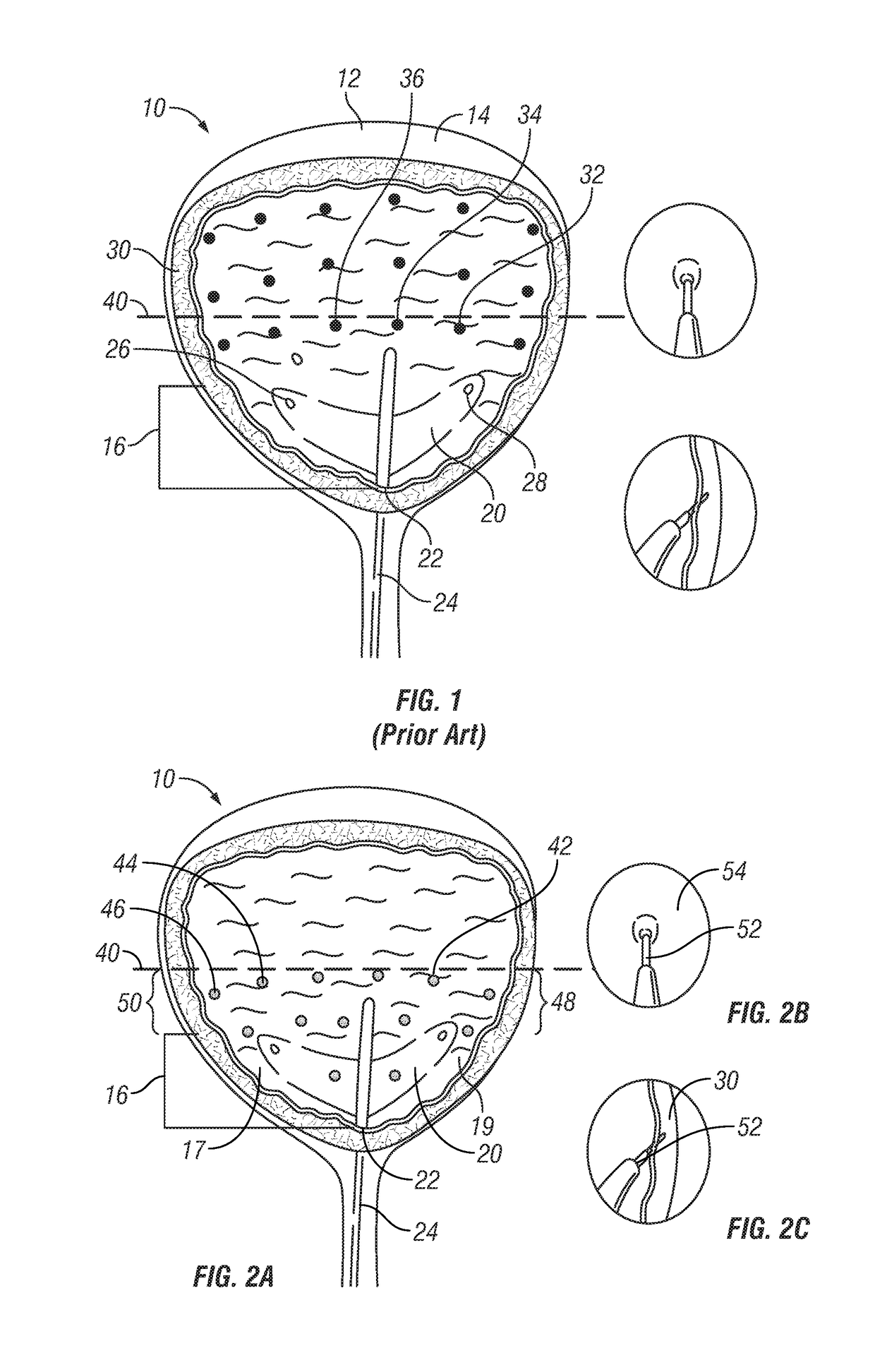 Bladder injeciton paradigm for administration of botulinum toxins