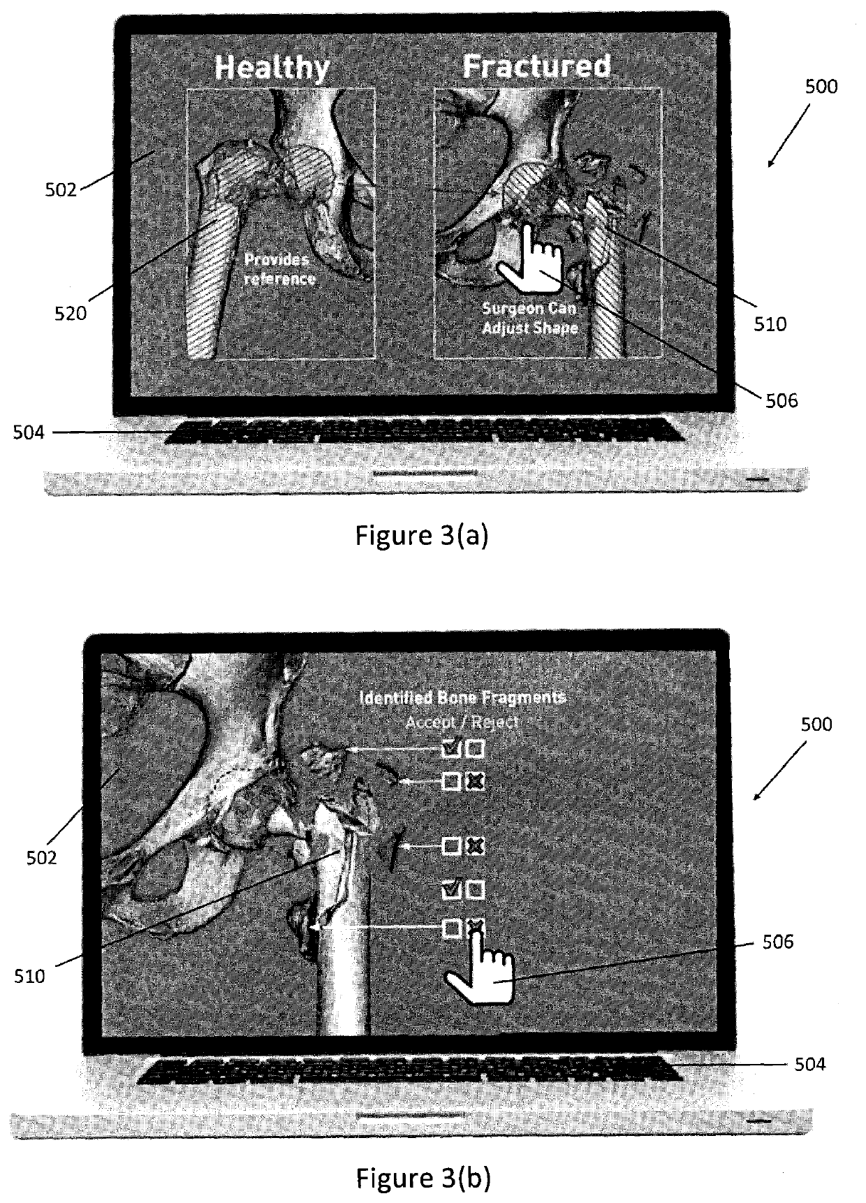 Bone model, modelling process and system therefor