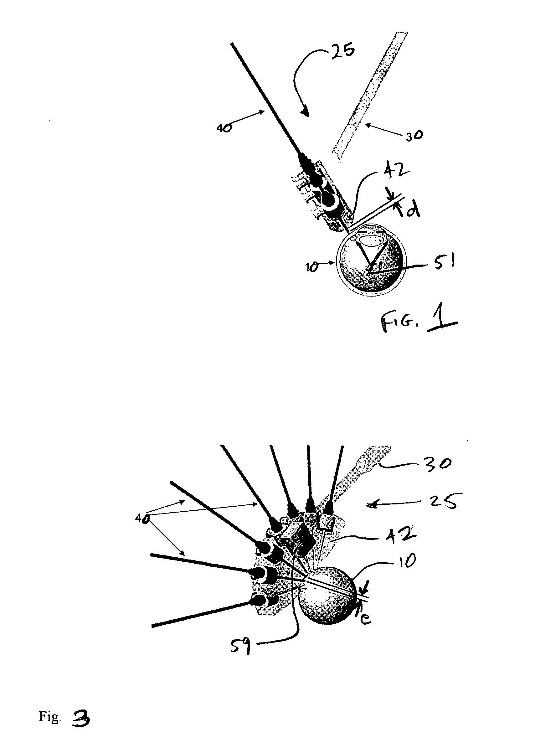 Device for the irradiation of the ciliary body of the eye