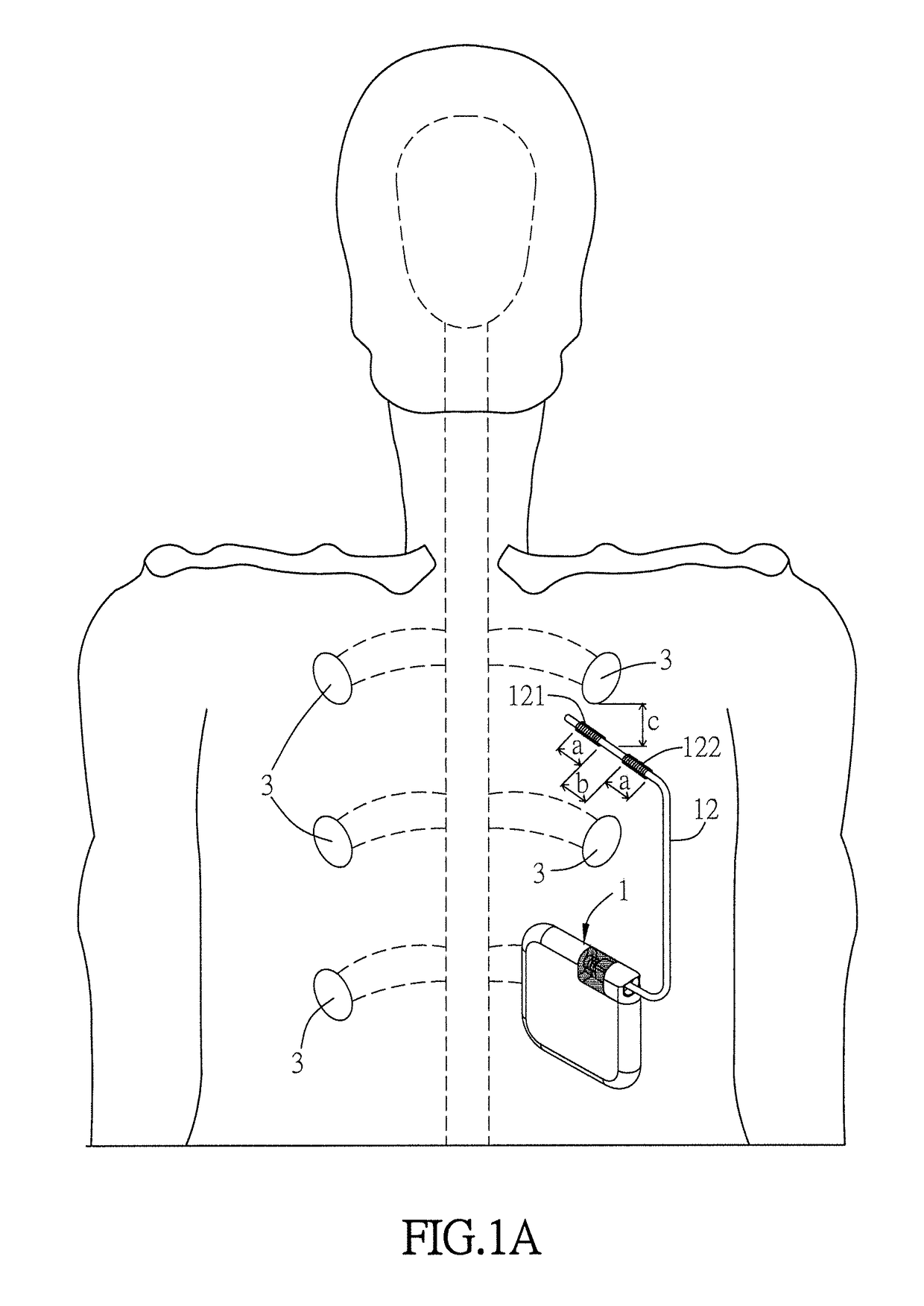 Method for reducing overactive bladder syndrome and computer-readable medium thereof