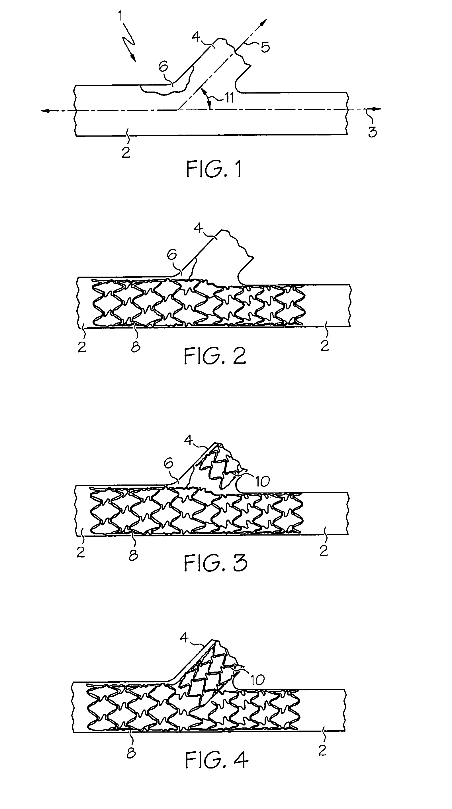 Stent with protruding branch portion for bifurcated vessels