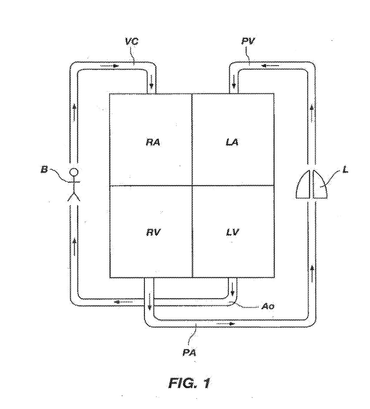 Pulmonary artery banding device