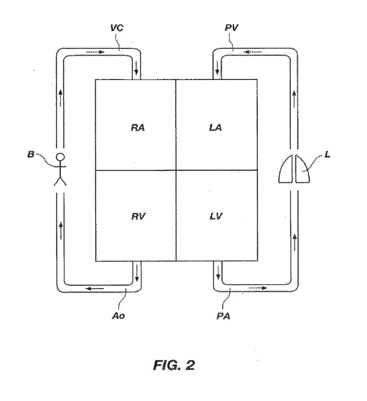 Pulmonary artery banding device