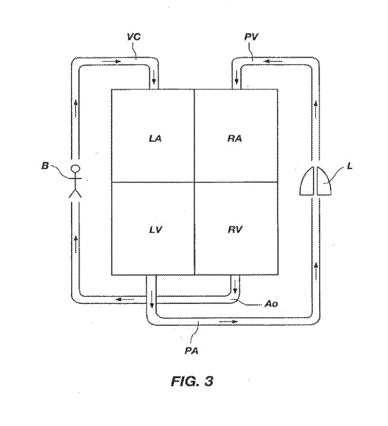 Pulmonary artery banding device