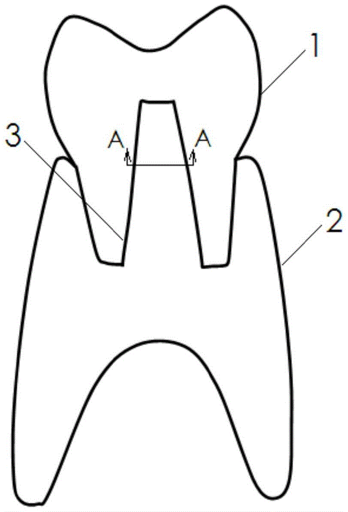 Split NC Machining and Adhesive Forming Method of Multicolor Resin Denture Base