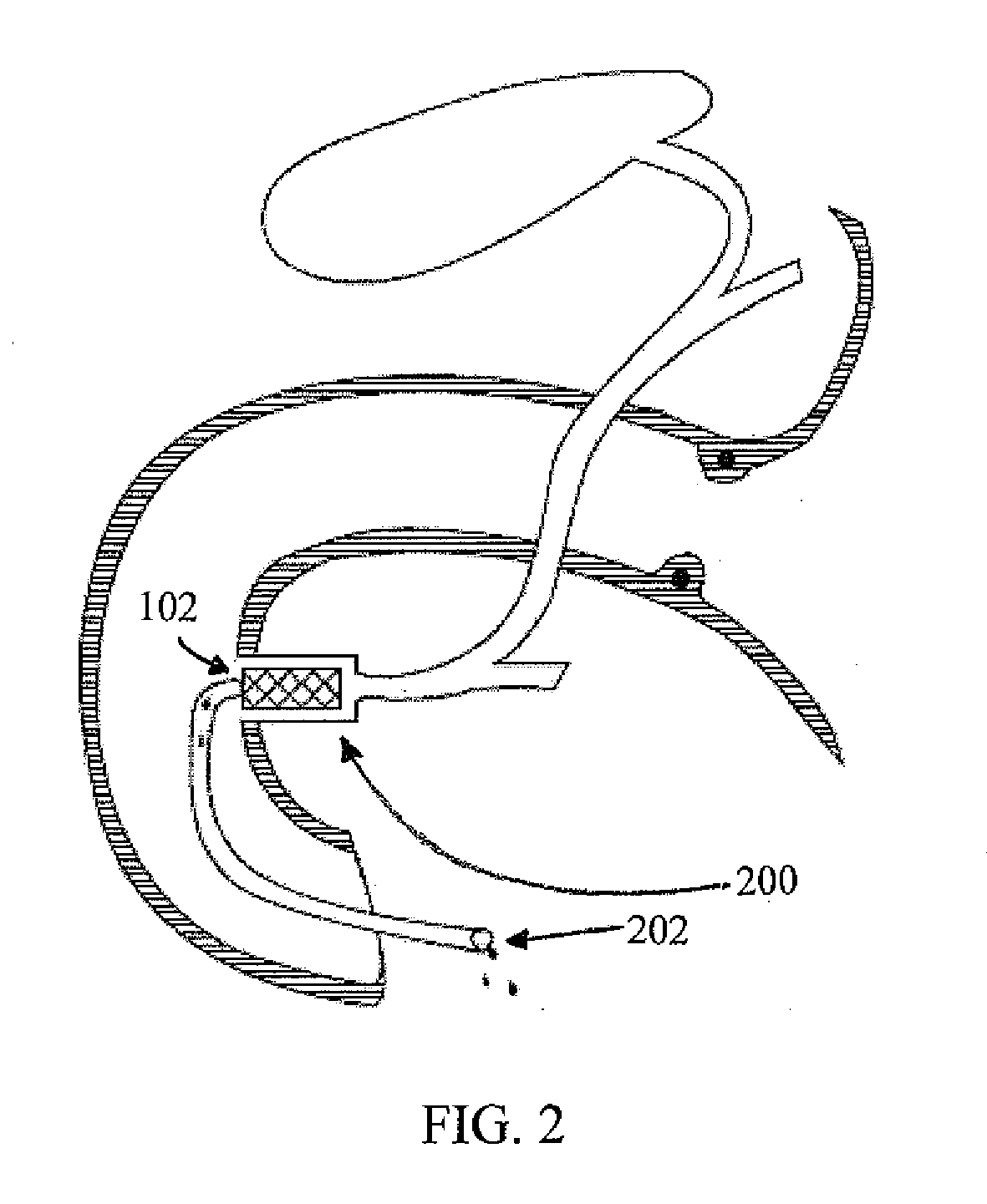 Method For Surgically Treating A Patient By Deactivating A Portion Of The Digestive Enzymes