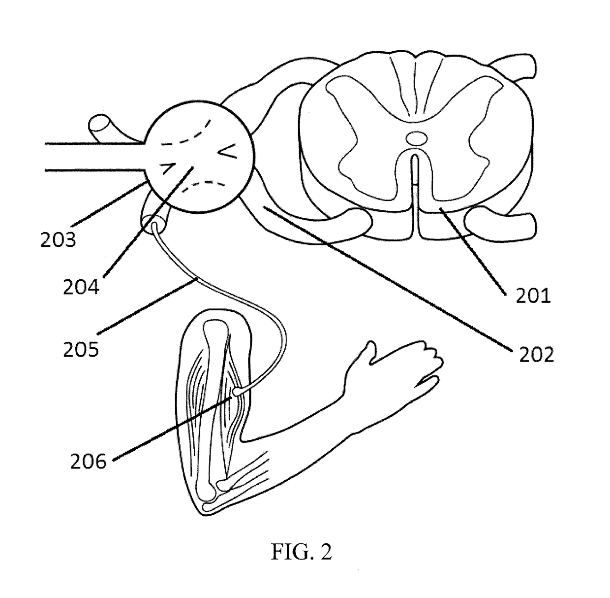 Systems and methods for spasticity treatment using spinal nerve magnetic stimulation