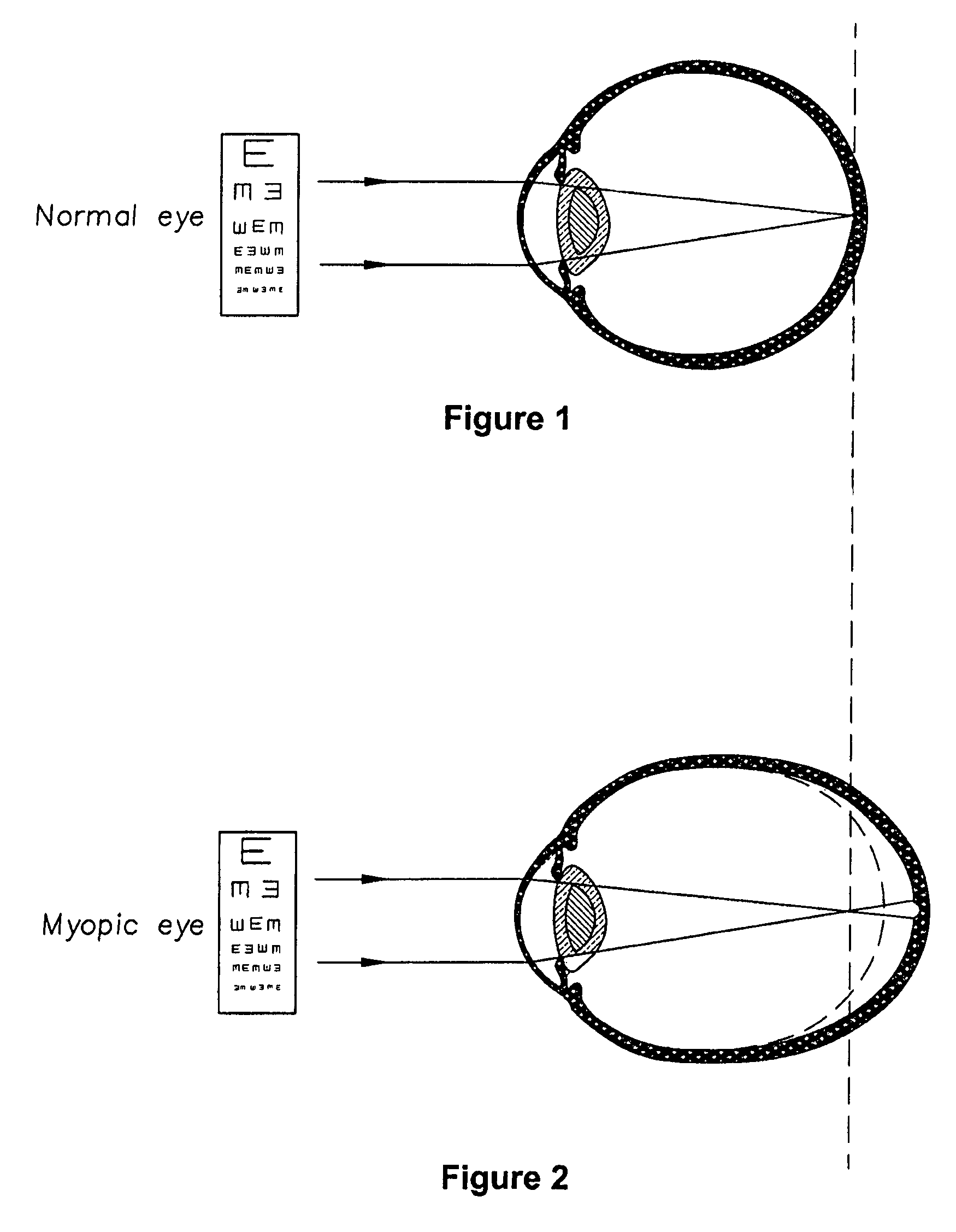 Contact lenses for myopic eyes and methods of treating myopia