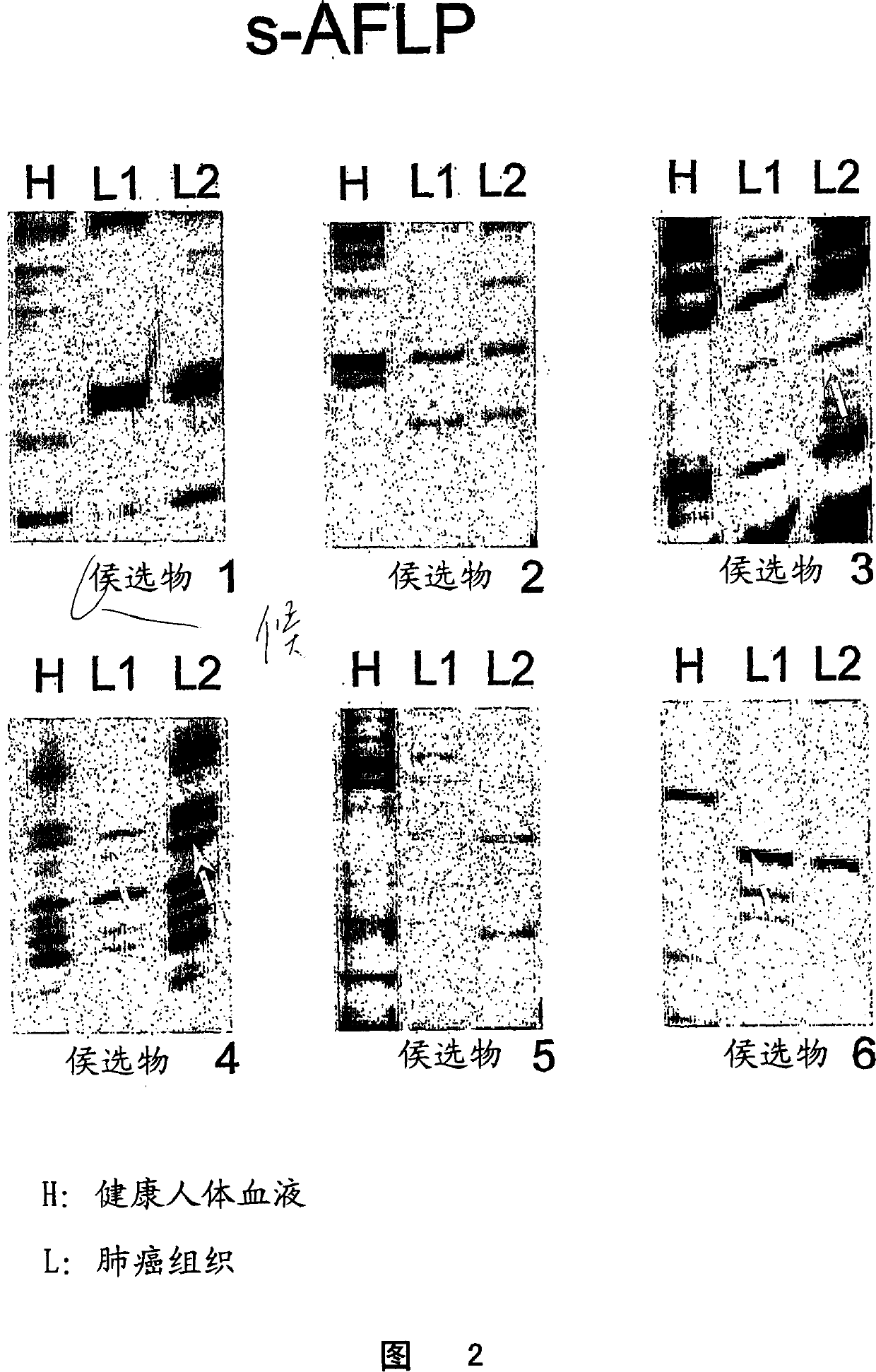 Gene markers for lung cancer