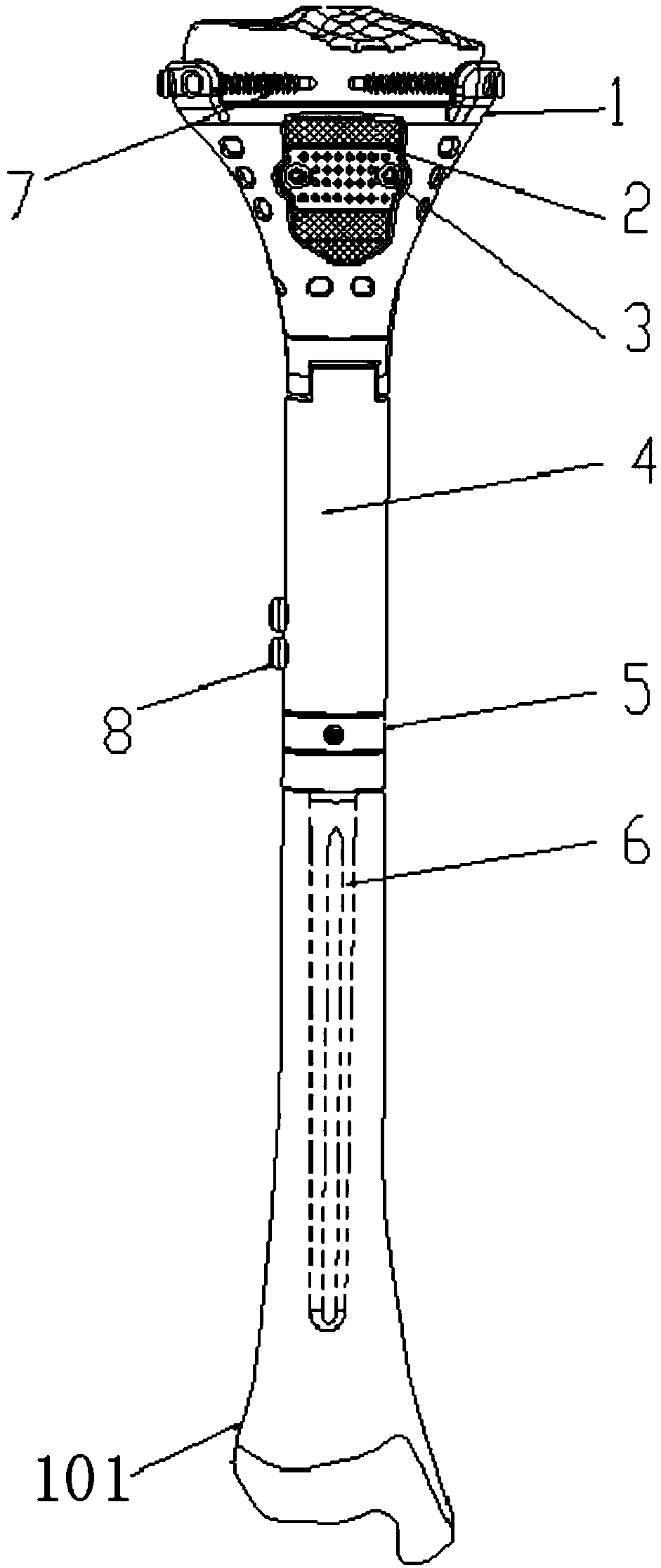 An extensible prosthesis for tibial tumor knee joint with preserved articular surface