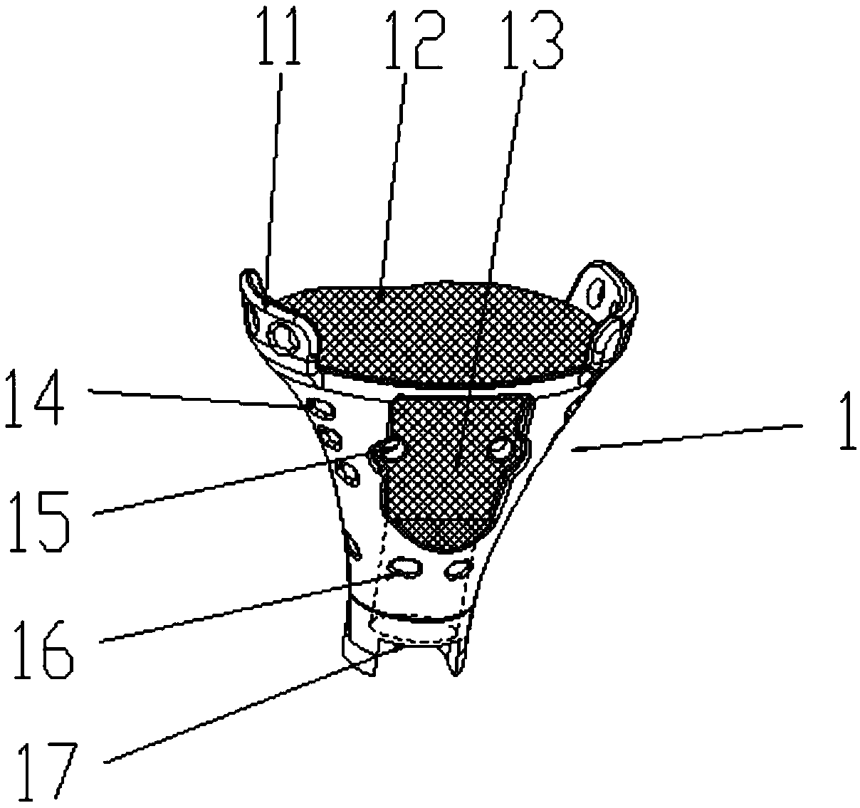 An extensible prosthesis for tibial tumor knee joint with preserved articular surface