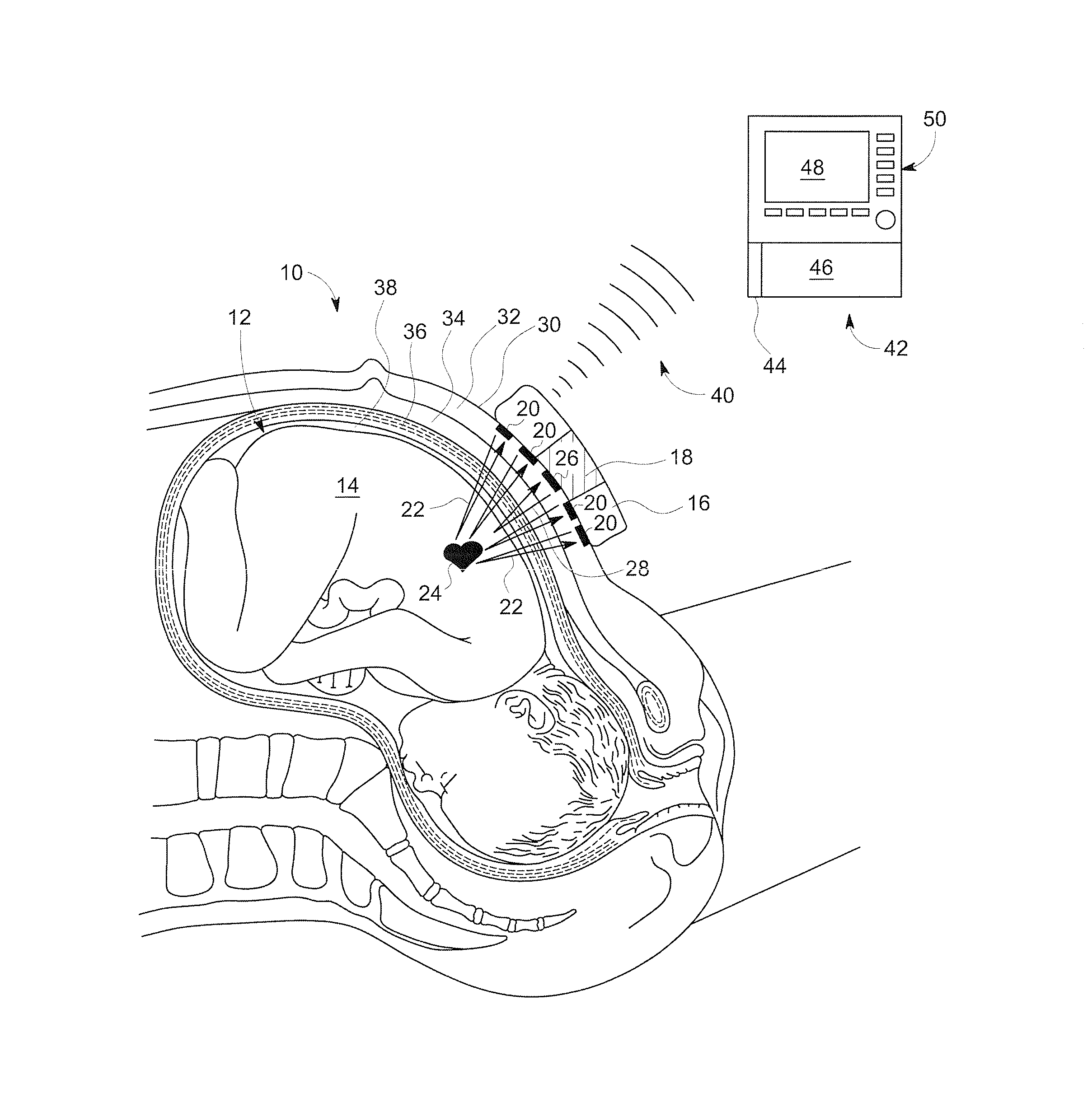 Abdominal sonar system and apparatus